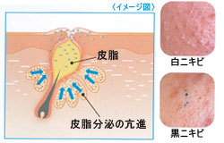 コメドの画像