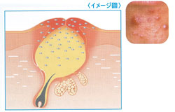 紅色丘疹の画像