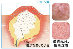 膿疱の画像