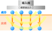 超音波導入（ソノフォレーシス）とは？